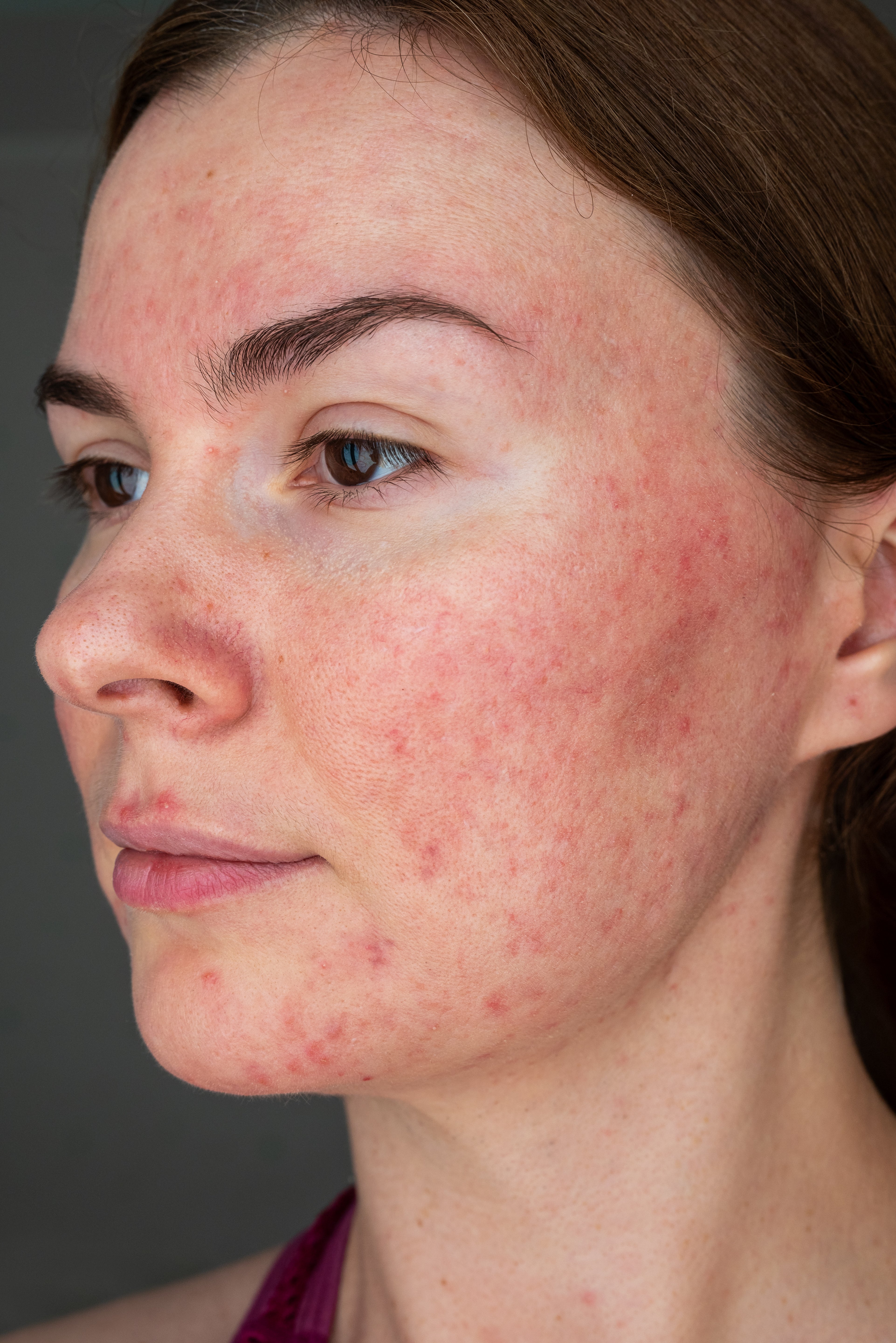 Rosacea